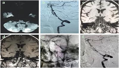 A retrospective study of individualized endovascular treatment for symptomatic intracranial atherosclerotic stenosis in patients with ischemic stroke/transient ischemic attack